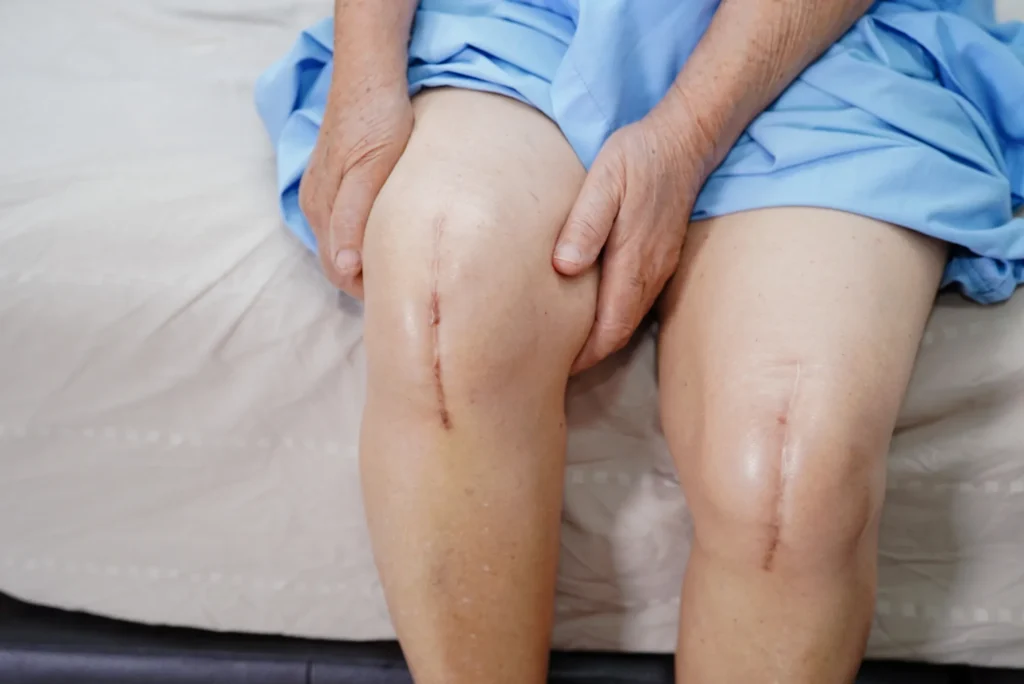 Artroplastia de rodilla bilateral qué esperar