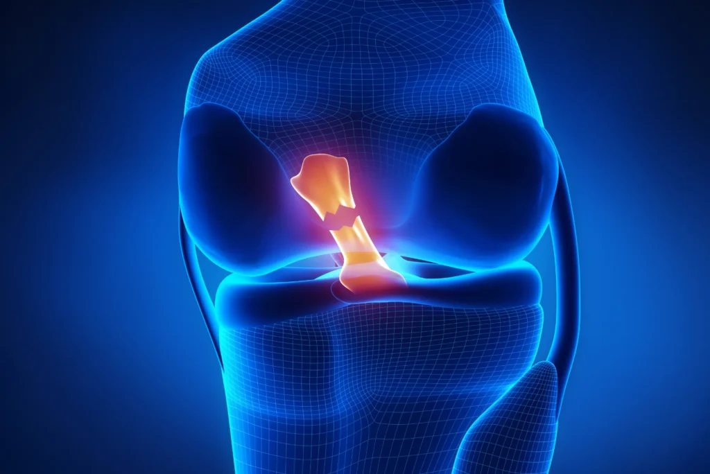 Ligamento cruzado anterior cirugía reconstructiva