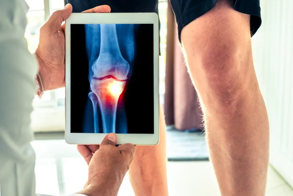 Osteoartritis de rodilla ¿es cirugía la solución