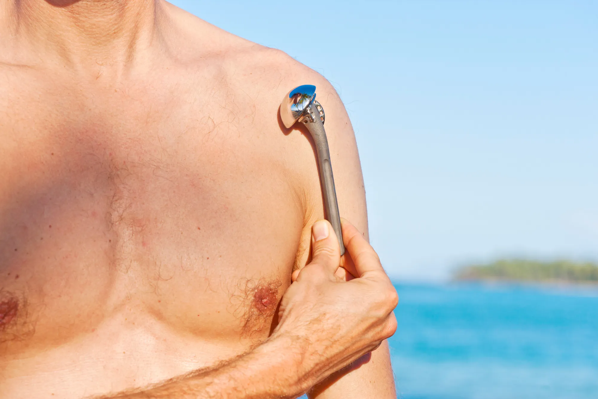 Prótesis de hombro ¿cuánto cuesta en méxico