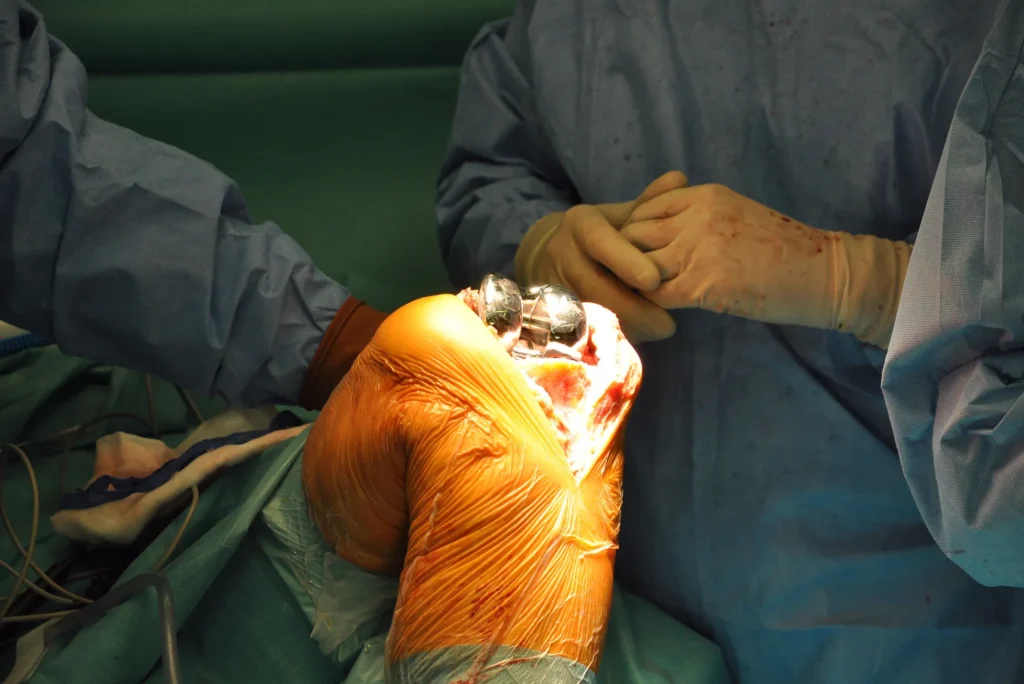 Prótesis de rodilla tipos y duración