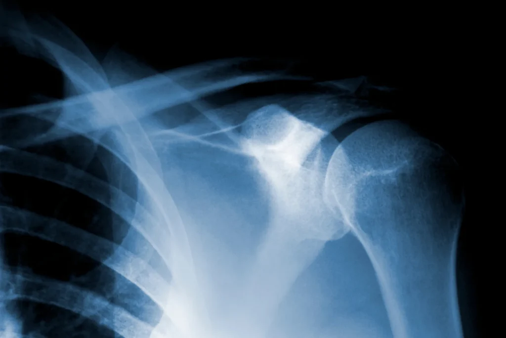 Tendinitis calcificante hombro tratamiento quirúrgico