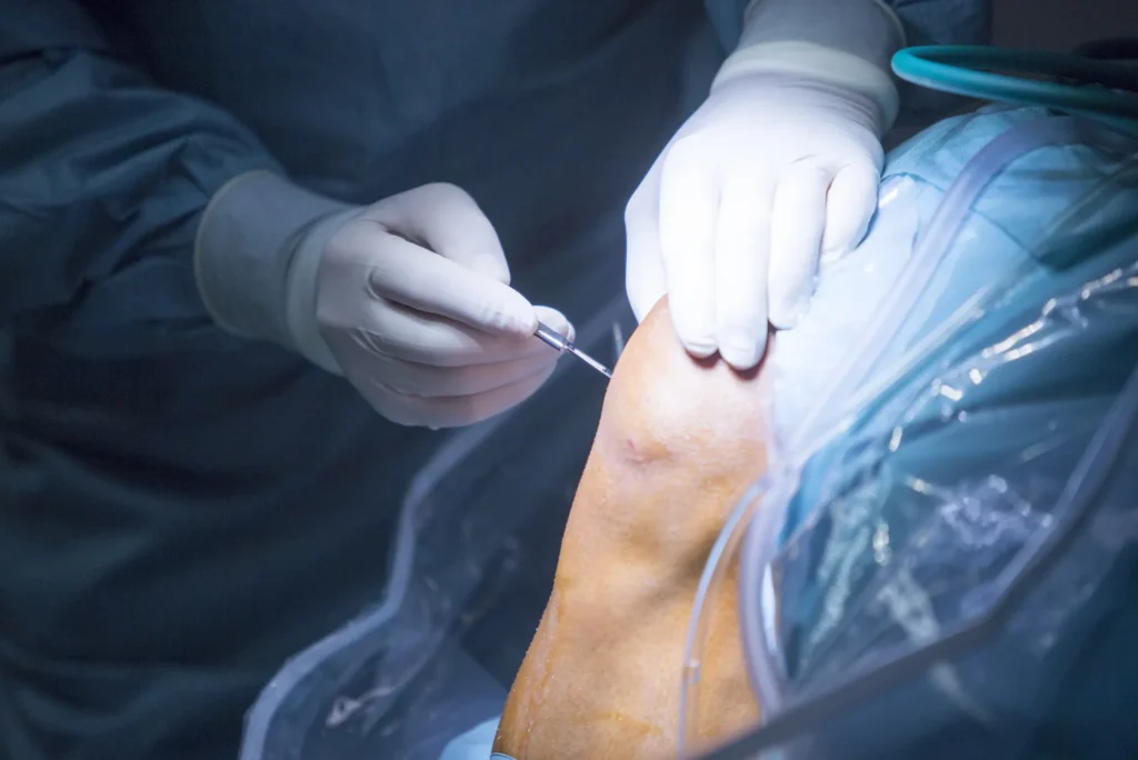 Artroscopia de rodilla recuperación en semanas