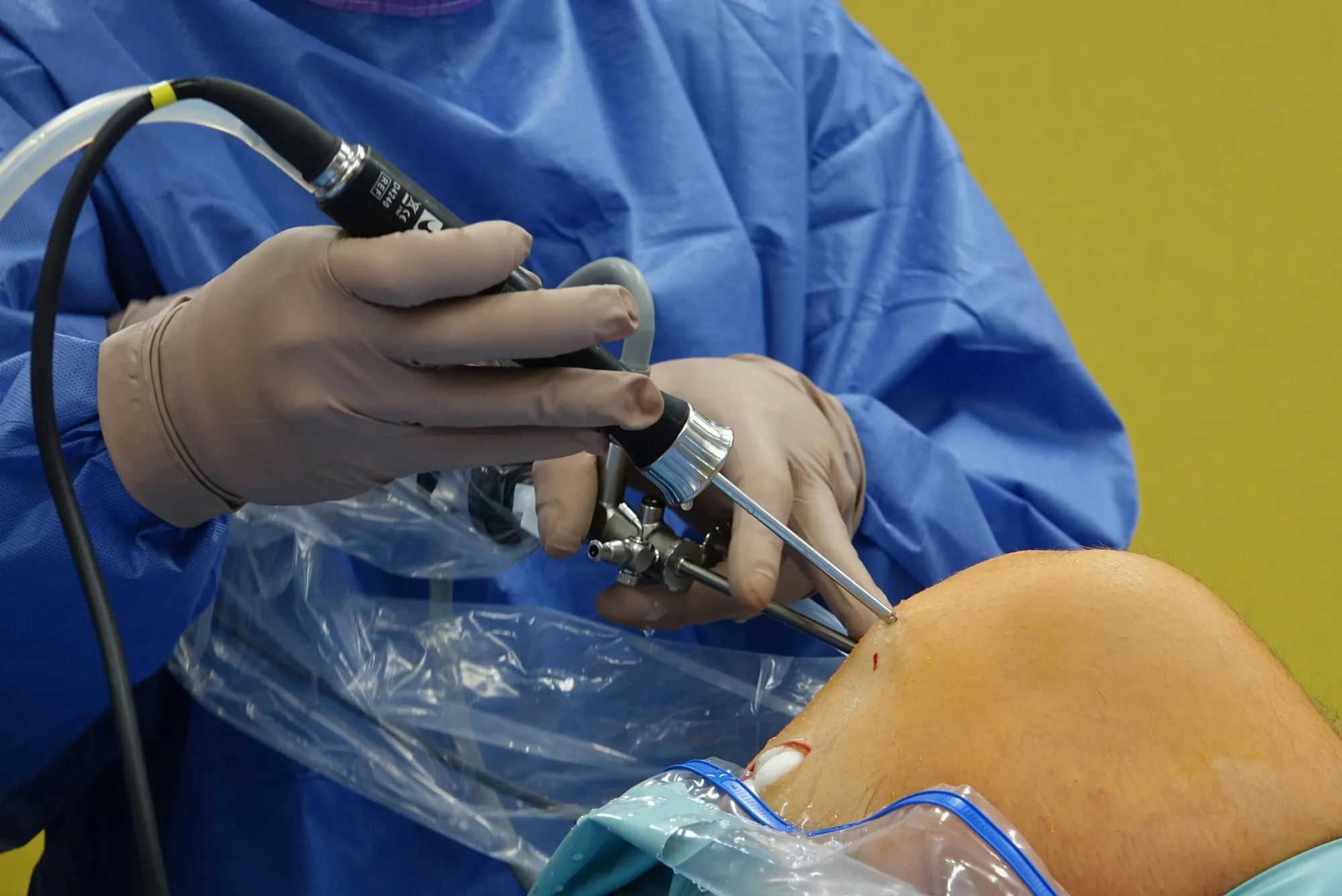 Es eficaz la reparación de lca con injerto autólogo