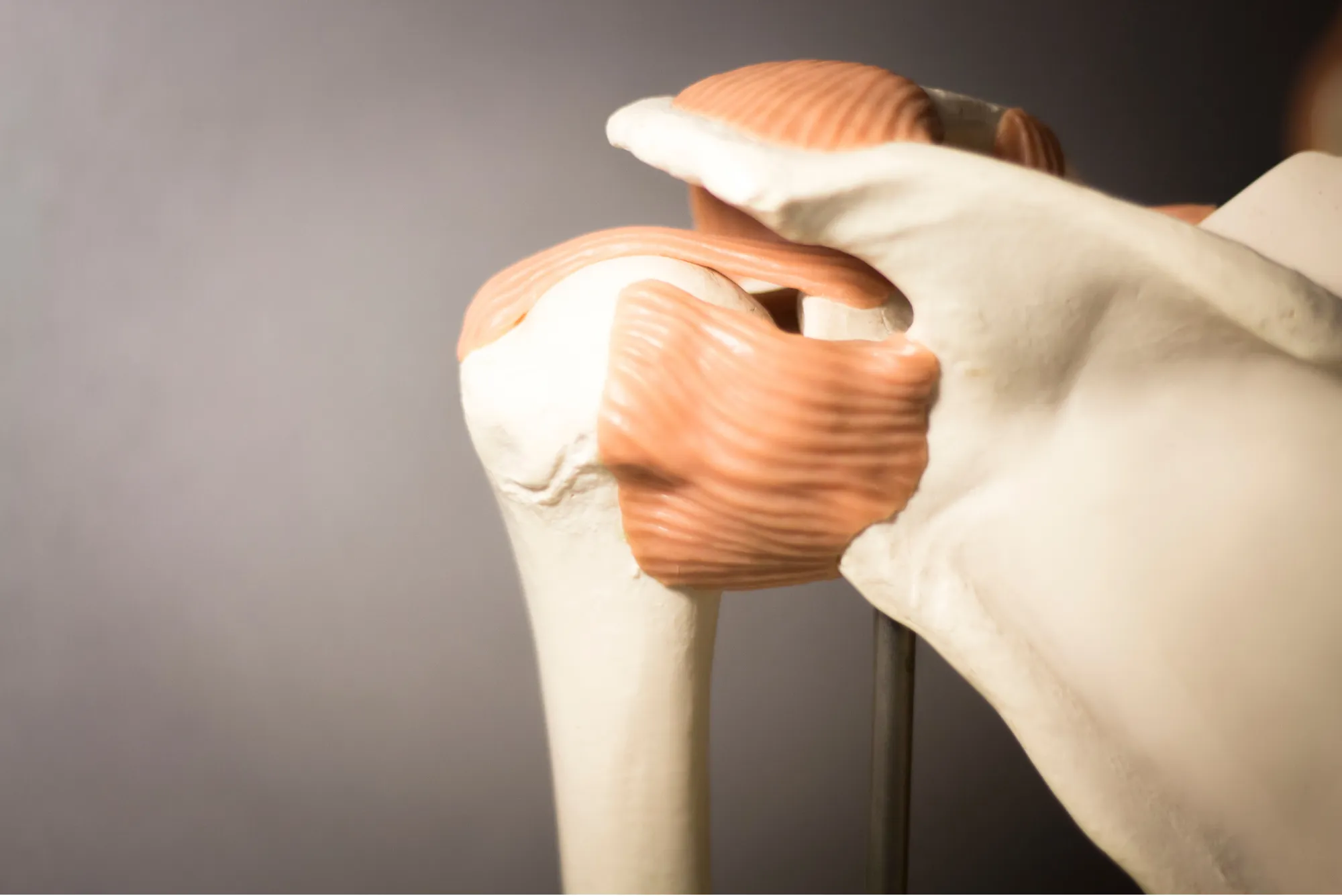 Plástico de tendones en hombro en qué consiste