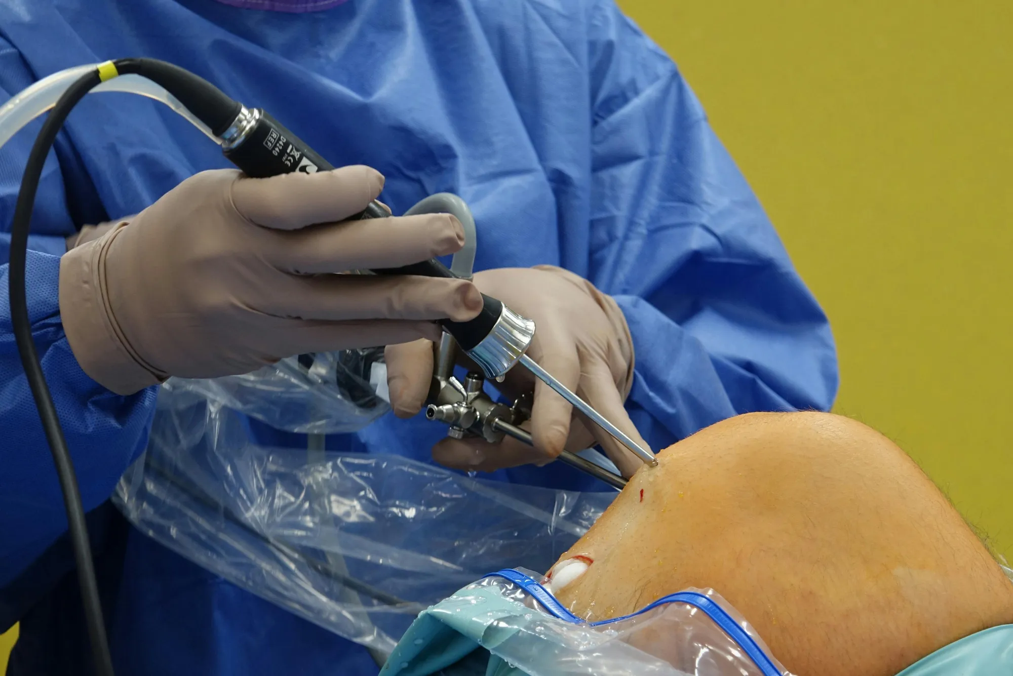 Prótesis de revisión en rodilla causas comunes