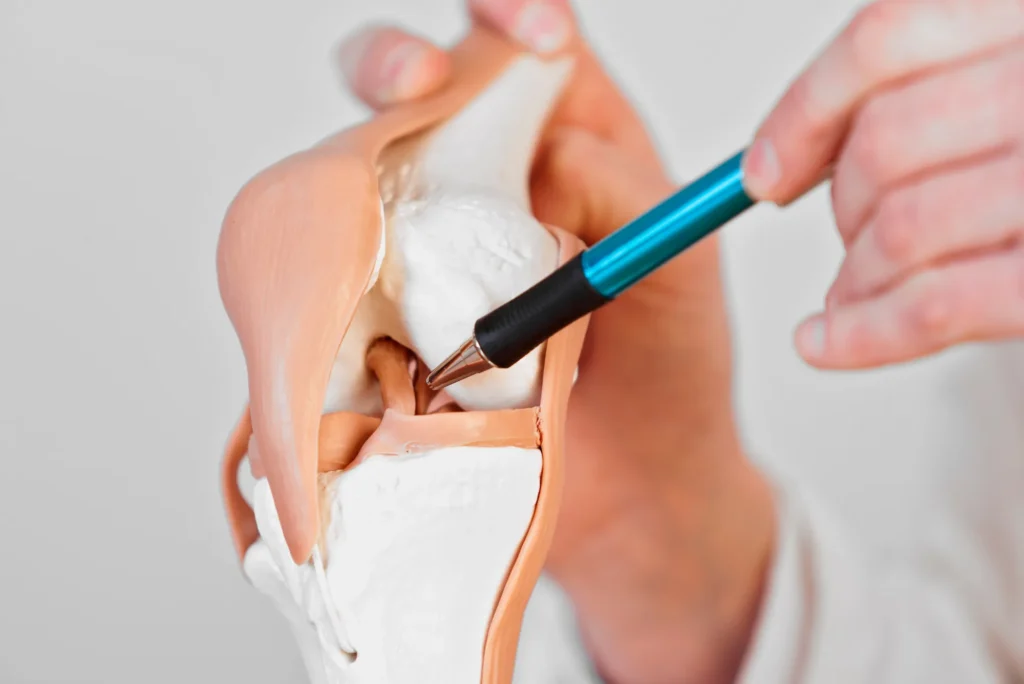 Qué esperar de la cirugía de ligamento cruzado anterior