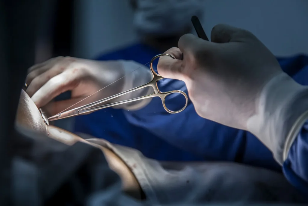 Rotura completa del manguito opciones quirúrgicas