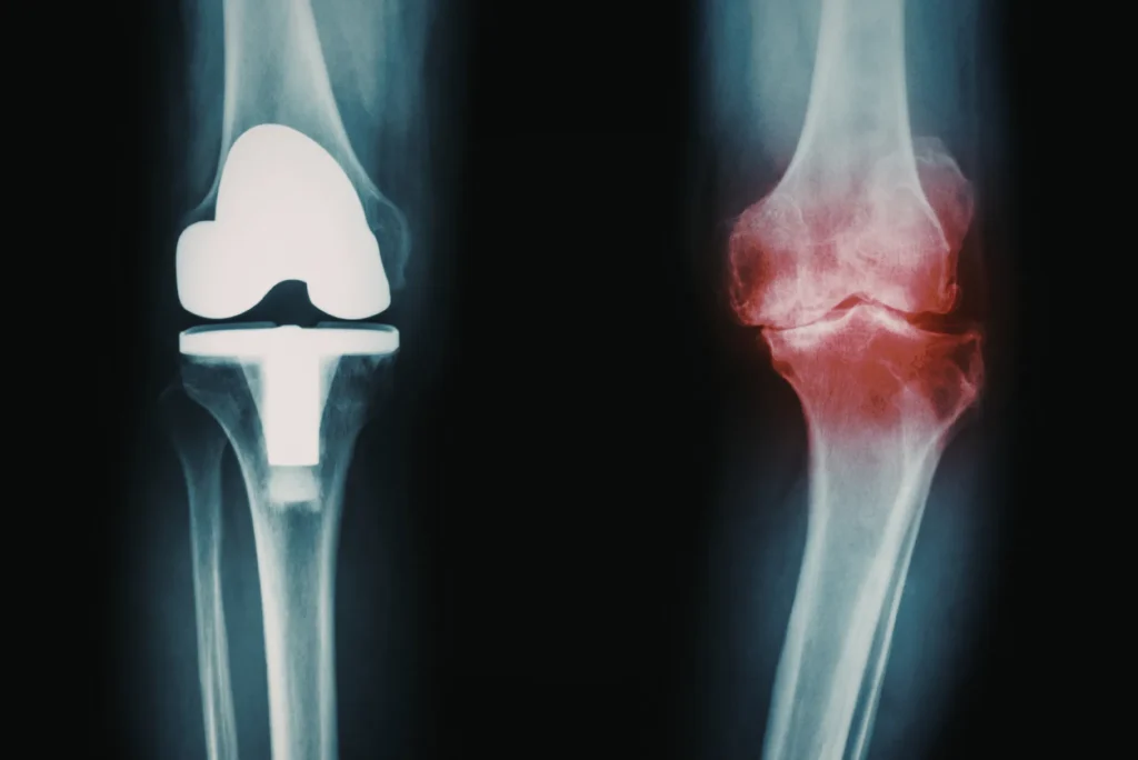 Rodilla artrítica cirugía o tratamiento conservador primero
