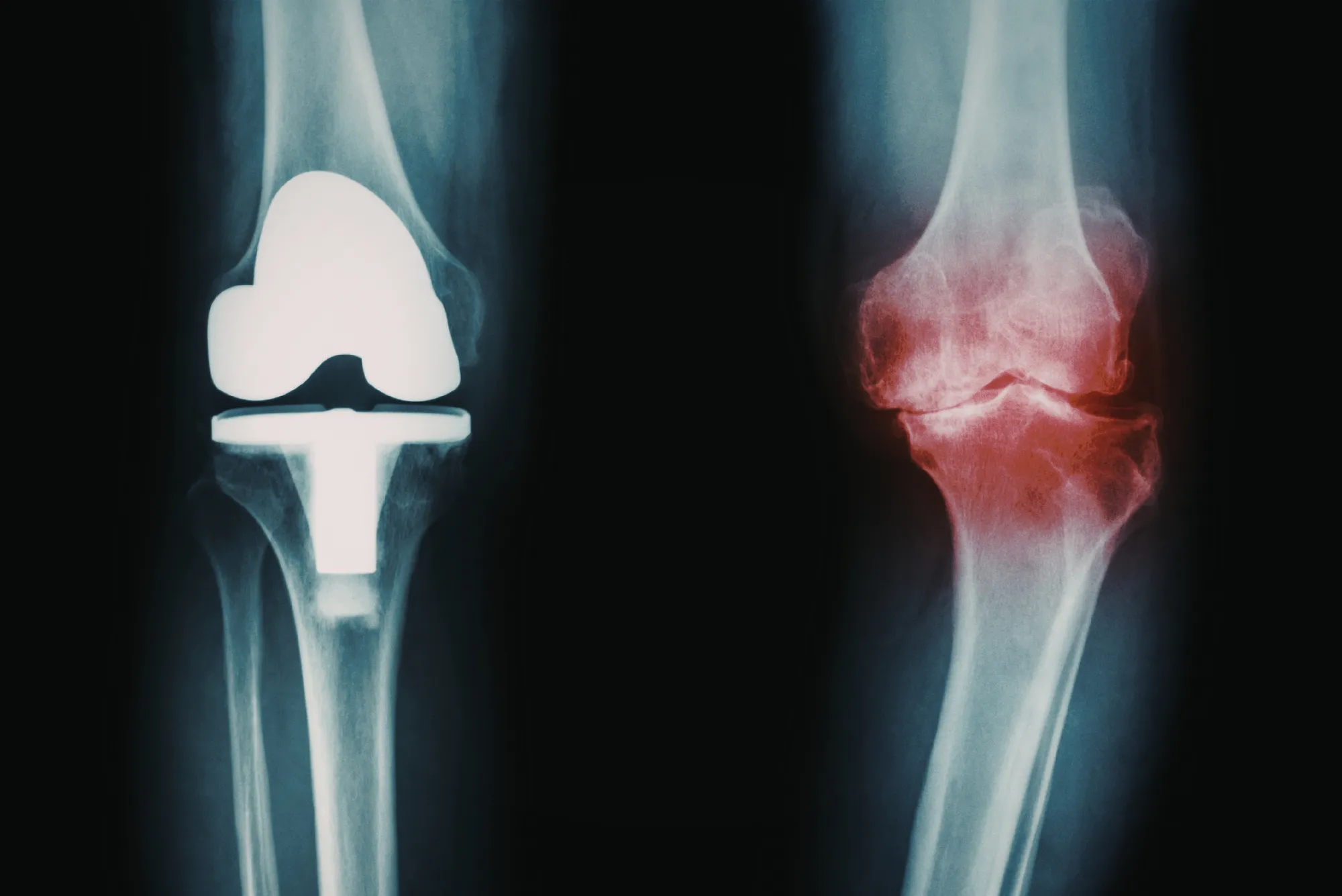 Comparación entre técnicas de implante de rodilla