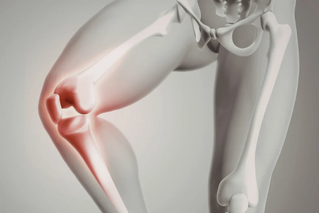 Impacto del peso corporal en resultados quirúrgicos de rodilla