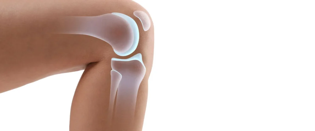 Cómo saber si necesito cirugía de rodilla