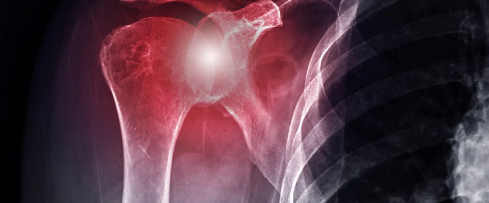 Deporte de alto impacto riesgos y beneficios de operar el hombro