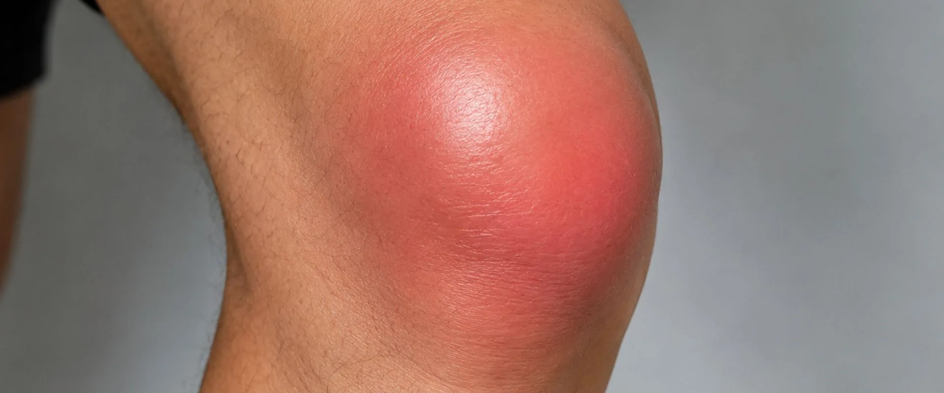 Rodilla inflamada cuándo considerar cirugía